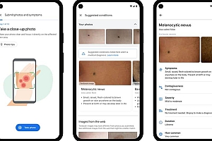Googe针对皮肤问题,开发了AI诊断工具